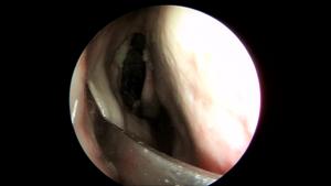 「看」吴彦桥教授讲泪前隐窝入路手术-不仅仅适用于上颌窦肿物切除